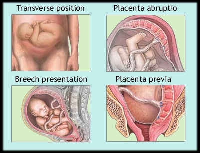 Placenta praevia